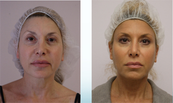 silhouette soft before thread facelift pre months